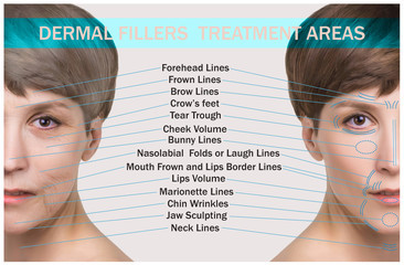 dermal fillers treatment areas
